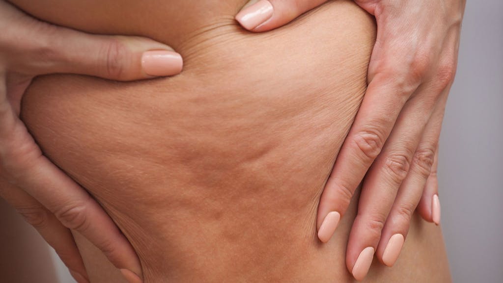 Cellulite