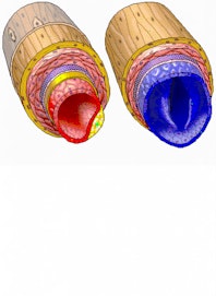 Atherosclerotic (Fat) Plaque