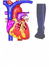 Blocked Coronary Vessel