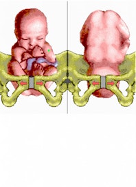 Breech Position