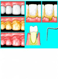 Cementum