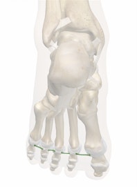 Deep Transverse Metatarsal Ligaments