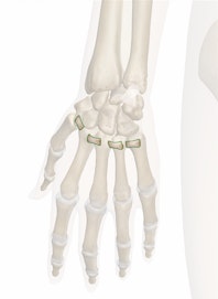 Dorsal Metacarpal Ligaments
