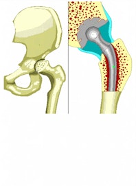 Femoral Component of Prosthesis