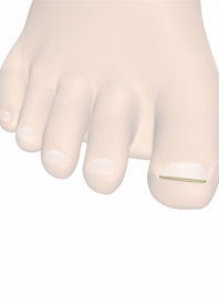 Free Edge of Toenail