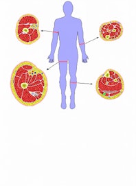Gastrocnemius Muscle (Medial Belly)