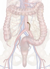 Inferior Mesenteric Artery