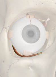 Inferior Oblique Muscle