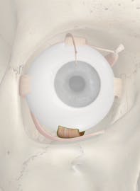 Inferior Rectus Muscle