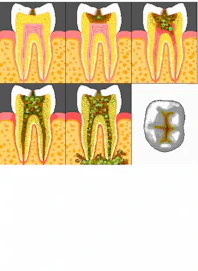 Inflammation of Pulp