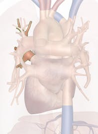 Left Superior Pulmonary Vein