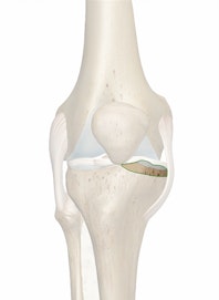 Medial Condyle of Tibia