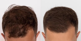 Minoxidil Before and After