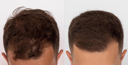 Minoxidil Before and After Photos