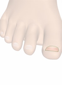Nail Body of Toenail