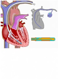 Pacemaker (Pulse Generator)