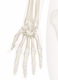 Palmar Metacarpal Ligaments