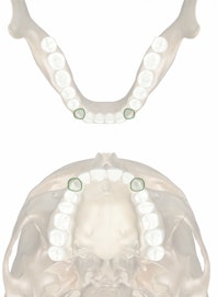 Permanent Canine 11-12th Yr