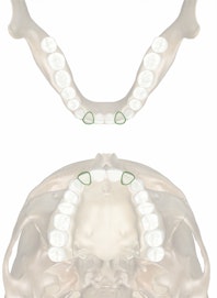 Permanent Lateral Incisor 8th Yr