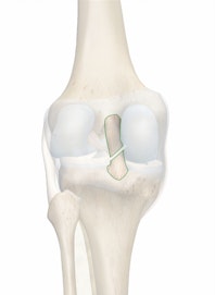Posterior Cruciate Ligament