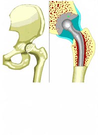 Prosthetic Acetabulum