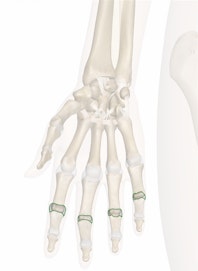 Proximal Interphalangeal (PIP) Joints of the Hand