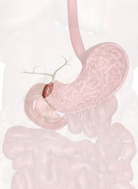 The Pyloric Sphincter