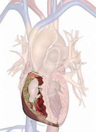 Right Ventricle
