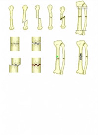 Screw for Fracture