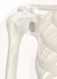 Subscapular Bursa to Shoulder Joint
