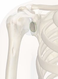 Subscapular Bursa to Shoulder Joint