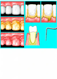 Swollen Gum