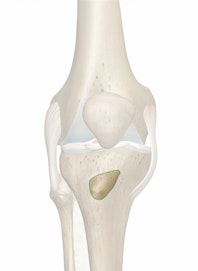 Tibial Tuberosity