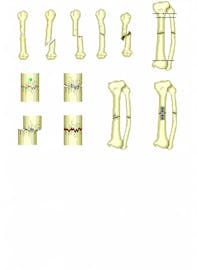 Union Fracture