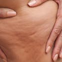 Cellulite: What It Is, Why It’s Normal, and How to Treat It