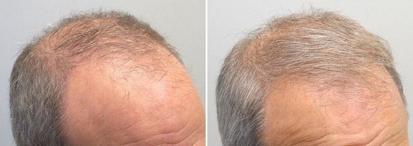 Finasteride and minoxidil before and after 12 months photo 2
