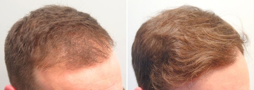 Finasteride and minoxidil before and after 12 months photo 3