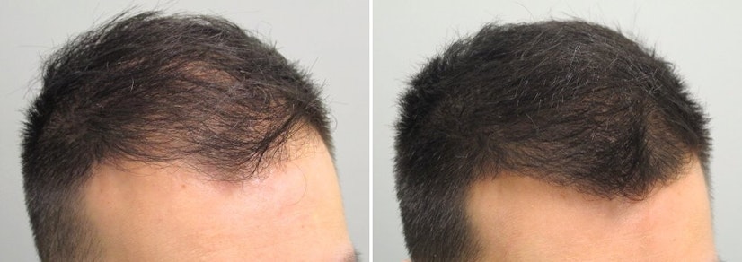Finasteride and minoxidil before and after 12 months photo 4