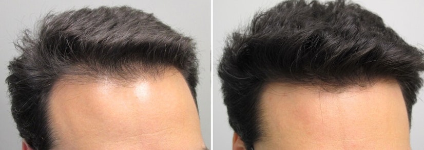 Finasteride and minoxidil before and after 12 months photo 5