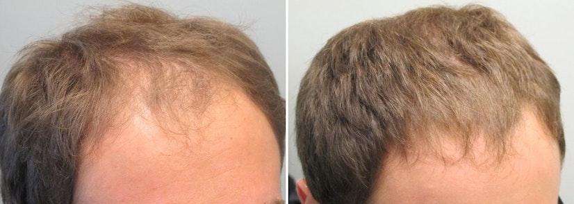 Finasteride and minoxidil before and after 12 months