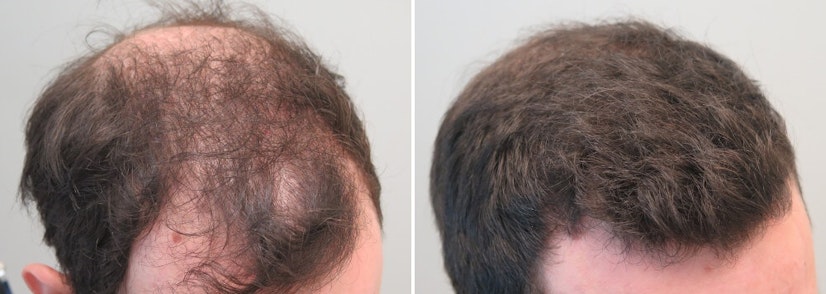 Finasteride and minoxidil before and after 13 months photo 2