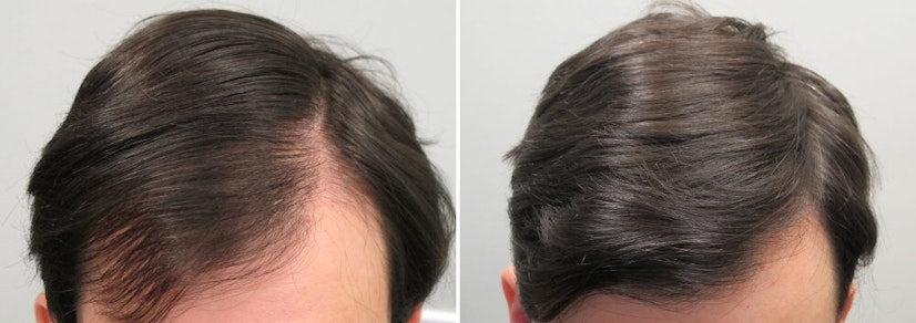 Finasteride and minoxidil before and after 13 months