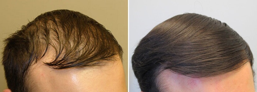 Finasteride and minoxidil before and after 14 months photo 2