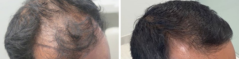 Finasteride and minoxidil after 14 months
