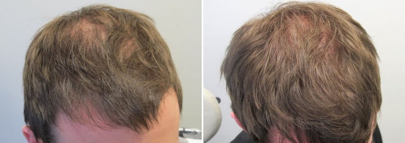 Finasteride and minoxidil after 17 months