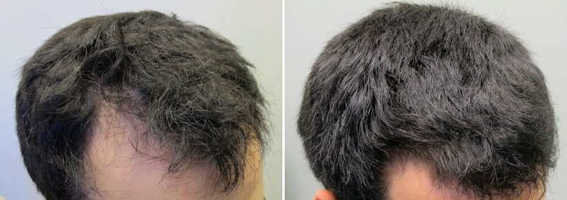 Finasteride and minoxidil after 2 years photo 2