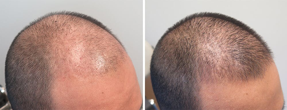 Hound andrageren Bering strædet Minoxidil Before and After Photos [2023] | Is it right for you?