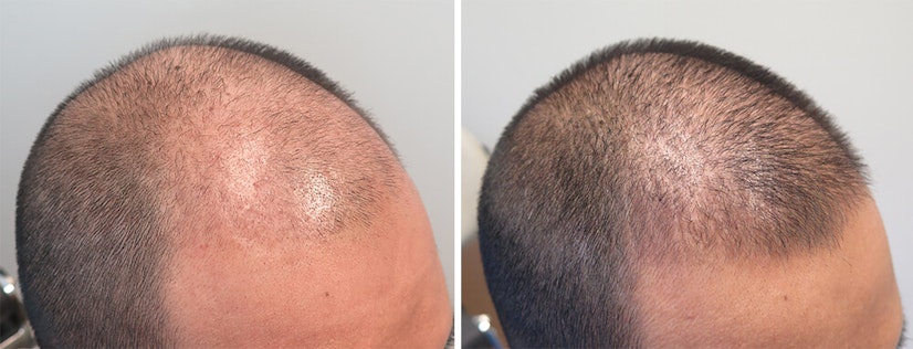 Finasteride and minoxidil after 2 years