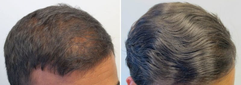 Finasteride and minoxidil before and after 21 months.