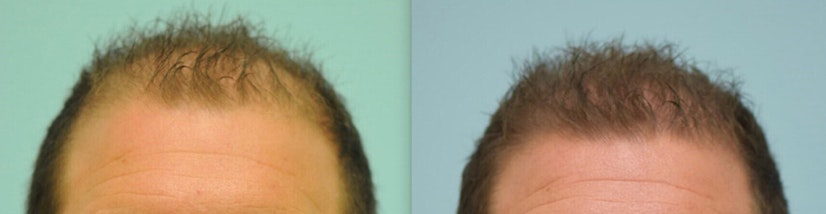 Finasteride and minoxidil before and after 6 months